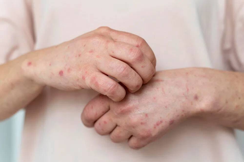 Dấu hiệu thường gặp khi mắc bệnh đậu mùa khỉ