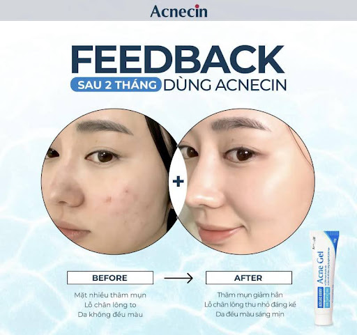 Acnecin - Chìa Khóa Cho Làn Da Tươi Sáng và Sạch Mụn
